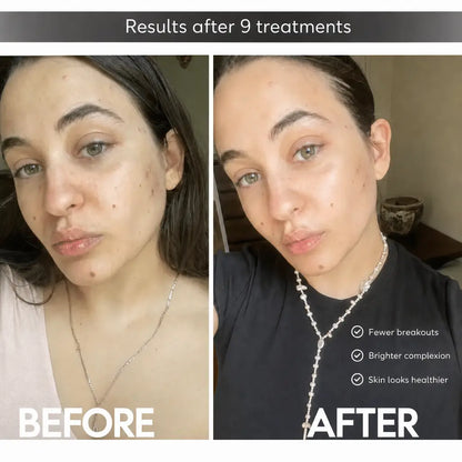 Celluviaa FaceLift Pro 6-in-1 - At-Home Skincare